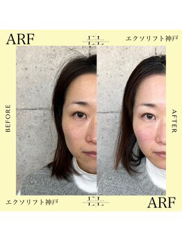 アーフ(ARF)/エクソリフト
