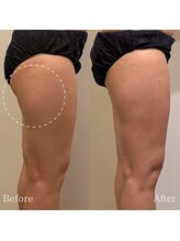 エル(Elle)/【痩身】浮腫み/美尻/太ももケア