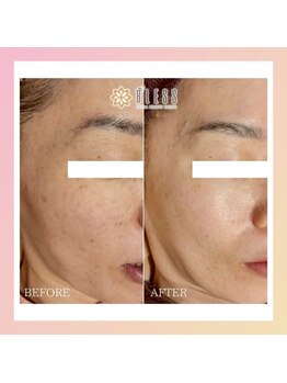 エステサロン ブレス 長町南店(BLESS)/シミ結果