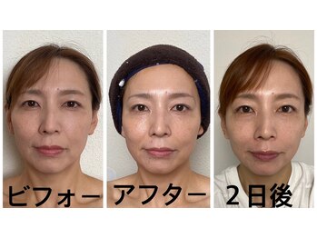 アクアナチュラ(ACQUANATURA)/1回でたるみ、むくみ改善