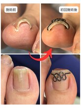 巻き爪矯正センター 沖縄 宜野湾/巻き爪矯正