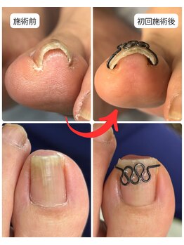 巻き爪矯正センター 沖縄 宜野湾/巻き爪矯正