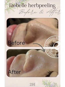 SDルーム/リベルハーブ　毛穴改善