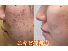 美的アヴェニール(美的.Avenir)の雰囲気(【水素×美容】水素洗浄×プラズマ《アクネ菌除去》保湿仕上げ)