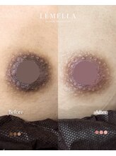 エルビービュティーサロン(LB BEAUTY SALON)/【ルメラ乳輪】実績数関西1★