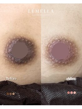 エルビービュティーサロン(LB BEAUTY SALON)/【ルメラ乳輪】実績数関西1★