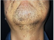 ブルハ(Bruja)/男性必見！ヒゲ脱毛♪　1