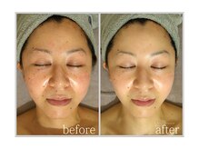 アン グレーヌ 自由が丘(unegraine)/赤み、くすみ解消へ…