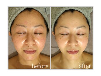 アン グレーヌ 自由が丘(unegraine)/赤み、くすみ解消へ…