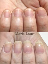 マリーロール 梅田店(Marie Laure)/深爪矯正/自爪育成/自爪風