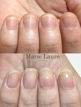 マリーロール 梅田店(Marie Laure)/深爪矯正/自爪育成/自爪風