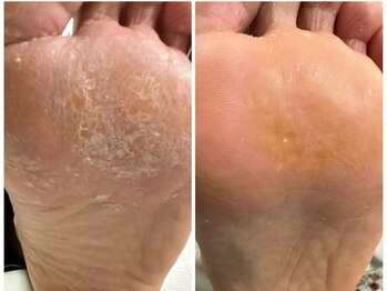 クク(KUKU)の写真/トラブルフットケアマスターによる【本格角質ケア￥2700】でつるつる足裏に♪タコ/魚の目/巻き爪も対応可能