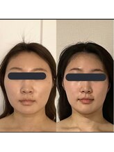 ハイコガオ 中崎町店(HIKOGAO)/小顔矯正