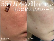 アリィ(Alii hisaya)の雰囲気（【トロイアルケ】毛穴に針を植え込む韓国最新ハーブピーリング）