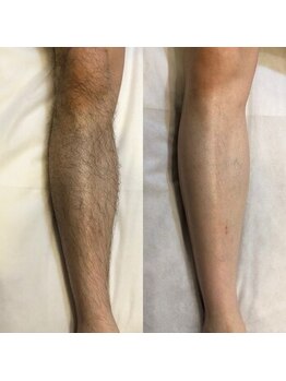 メンズプシュケ(men's PSYCHE)/膝下脱毛3回目