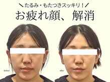 REGISTA ボディ&フェイシャルケアサロン/筋膜リリース/小顔矯正/実例！小顔矯正