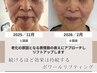 【たるみ改善＋乾燥小ジワ】表情筋リフトUP＋ヒアルロン導入 ￥18100→￥9600