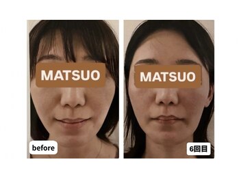 マツオ(MATSUO)の写真/顔に触れずに、小顔を目指す新発想。人気NO.1「小顔ボディメニュー」