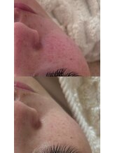 ナチュリー(Naturry)/赤み、敏感肌改善