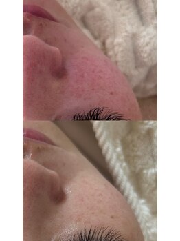 ナチュリー(Naturry)/赤み、敏感肌改善