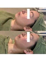 リムビューティー 自由が丘(RymBeauty)/ツヤ感・なめらか肌[ララピール]