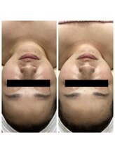 ランプ(LAMP)/～BBL光フェイシャル～