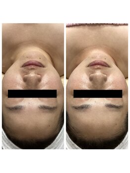 ランプ(LAMP)/~BBL光フェイシャル~