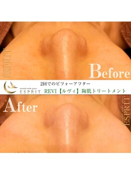 エスプリ 銀座店/ハーブピーリング銀座