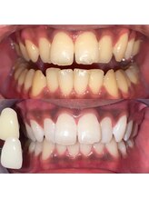 ペルレ(Perl)/本格ホワイトニング5回終了後