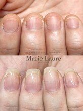 マリーロール 梅田店(Marie Laure)/深爪矯正/自爪育成/自爪風