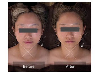 レーヴリゼ(Revelise)/頭蓋骨小顔矯正+整顔マッサージ