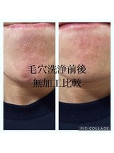 スムース イー(Smooth+E)/毛穴洗浄効果