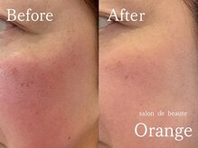 サロンドボーテ オランジュ(salon de beaute Orange)/赤み/一回の鎮静力/植物の力