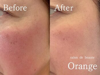 サロンドボーテ オランジュ(salon de beaute Orange)/赤み/一回の鎮静力/植物の力