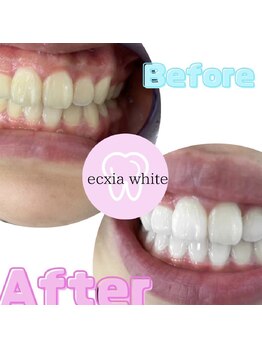 エクシアホワイト 平岸駅前店/ホワイトニングビフォーアフター