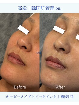 オン(on.)/施術一回での変化です♪