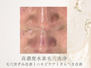 アネラボーテ(Anela Beaute)/高濃度水素毛穴洗浄アクアピール