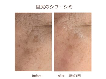 ブローディア(private estheticsalon Brodia)/ビフォーアフター