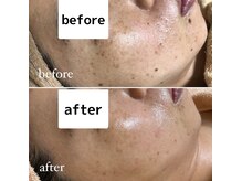 アンテイン(anthein)/肌質改善