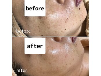 アンテイン(anthein)/肌質改善