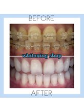 ホワイトニングショップ 芦屋店/お客様のビフォーアフター♪
