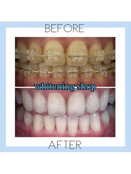 ホワイトニングショップ 芦屋店/お客様のビフォーアフター♪