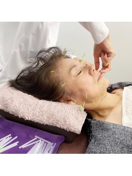 AZ美 整体院/美容鍼でリフトアップ