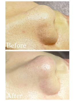 ジェンヌ(jenne.)/毛穴エクストラクション