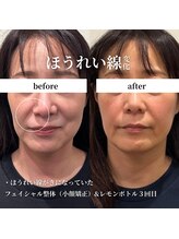 フェアリーフェイス 南森町店(Fairy Face)/南森町/小顔矯正&レモンボトル