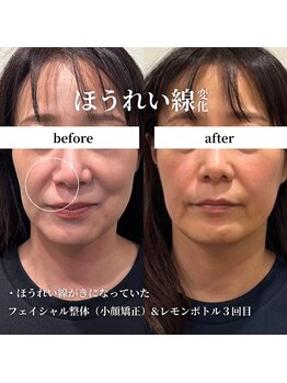 フェアリーフェイス 南森町店(Fairy Face)/南森町/小顔矯正&レモンボトル