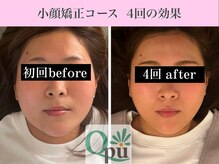 キュープ 表参道店(Qpu)/小顔矯正4回コースの変化