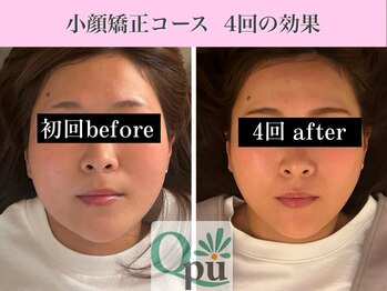 キュープ 表参道店(Qpu)/小顔矯正4回コースの変化