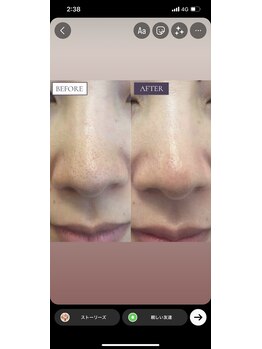 徳島美容サロン/クリスタルショットコース