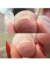 痛みがある巻き爪の補正